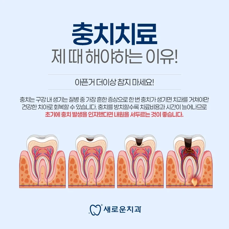 충치의 진행 단계와 진료 필요성을 설명하는 새로운치과 이미지