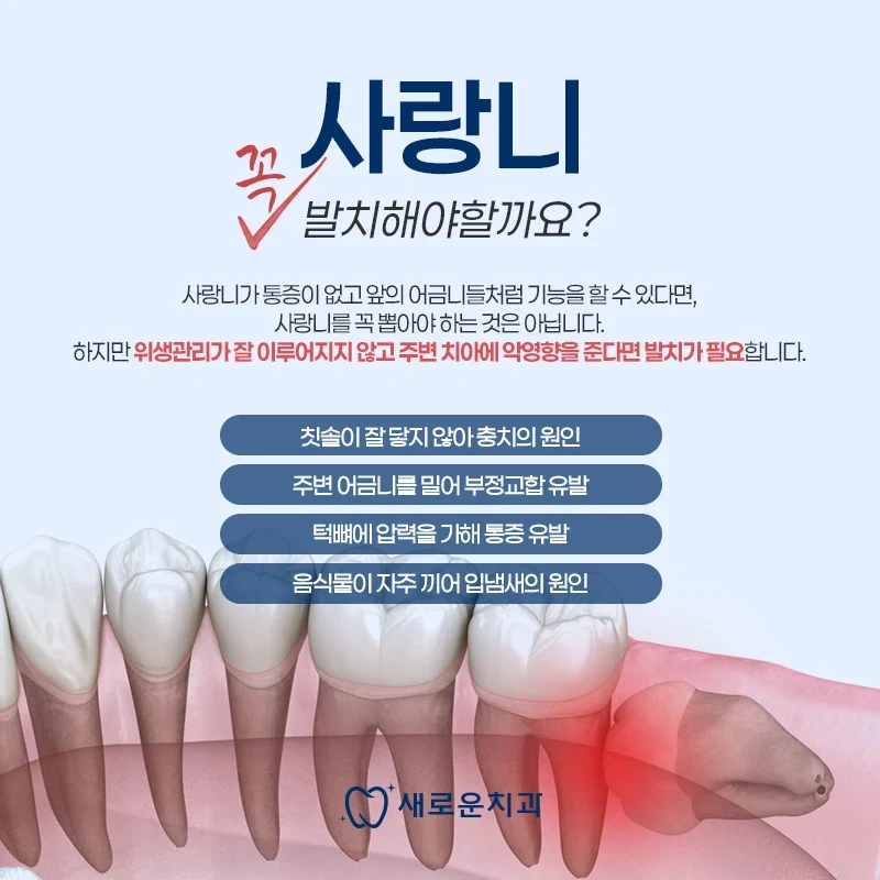 사랑니의 위치와 발치 필요성에 관한 새로운치과 안내